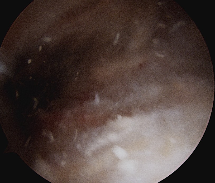 Calcific Tendonitis Arthroscopy 2